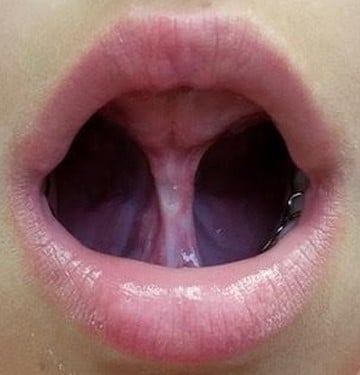 What You Need to Know about Frenectomy for Children in Los Angeles, CA