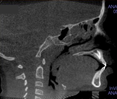 Beyond Sleep Struggles: How Your Pediatric Airway Dentist in Los Angeles is Redefining Children's Health in 2025