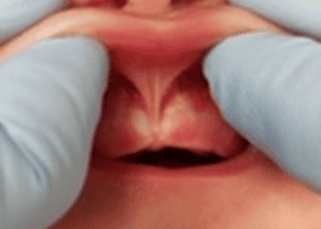 Pediatric dentist examining an infant’s upper lip frenulum for a possible lip tie, illustrating pediatric frenectomy evaluation and treatment in Los Angeles